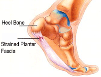 Plantar Fasciitis (heel pain) & Football